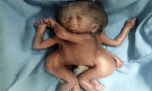 Read more about the article 4 पैरों वाले विचित्र बच्चे का जन्म
