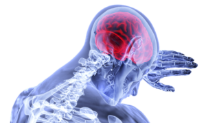 Read more about the article दिमाग की नस फटने का कारण BRAIN HEMORRHAGE की जानकारी