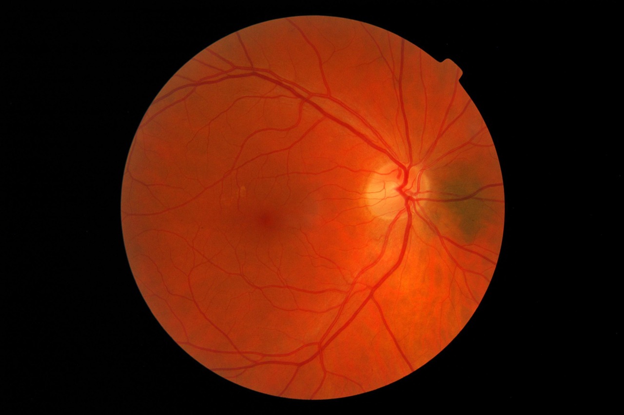 आंखों की रोशनी कम होने के कारण - Cataracts मोतियाबिंद