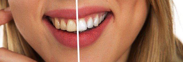 ‌‌‌दांतो के प्रकार बुद्धि दांत / तीसरी दाढ़ Wisdom Teeth