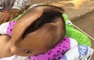 Read more about the article इस बच्चे के सर के बीचों बीच है दरार